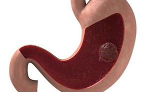 胃部超声检查可以检查出什么病