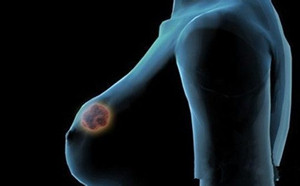 什么是乳腺结节